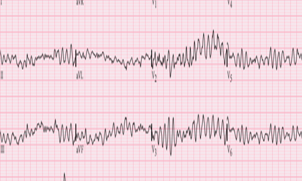 Heart Rhythm Monitor